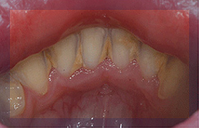 스케일링