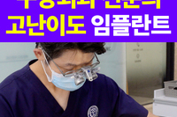임플란트 후 술과 담배는 언제부터 가능할까요? 구강외과 전문의가 전하는 사후관리